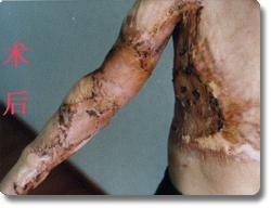 烧伤瘢痕图片,视觉解读与康复之道