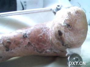 烧伤瘢痕图片,视觉解读与康复之道